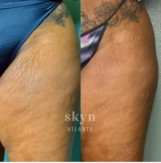 Micro Needling Stretch Marks Before and After