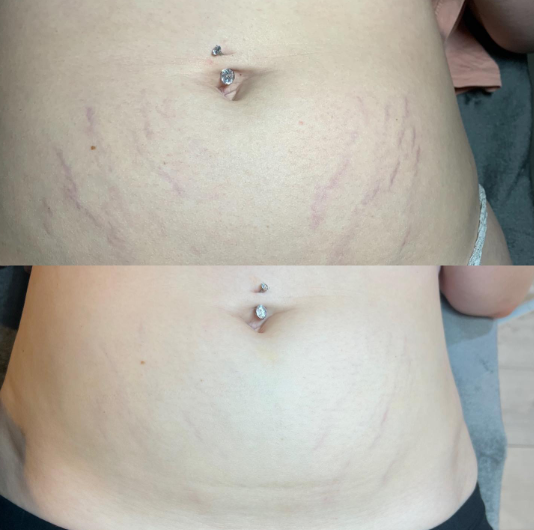 Microneedling for stretch marks