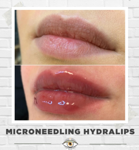 Microneedling lips