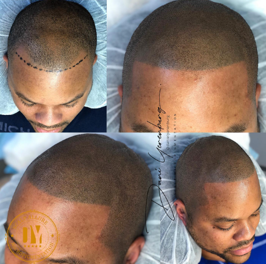 scalp micropigmentation last