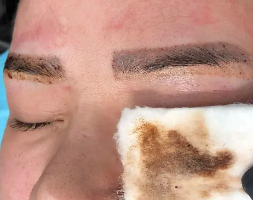 Eyebrow Tattoo Removal: How Does it Work and What to Expect