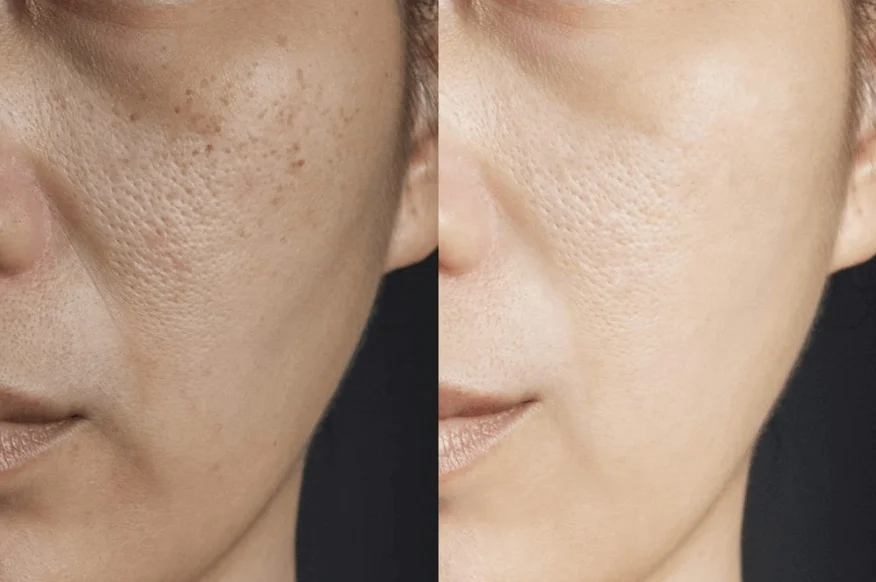 Day by Day Chemical Peel Recovery Peel, Reveal, And Heal