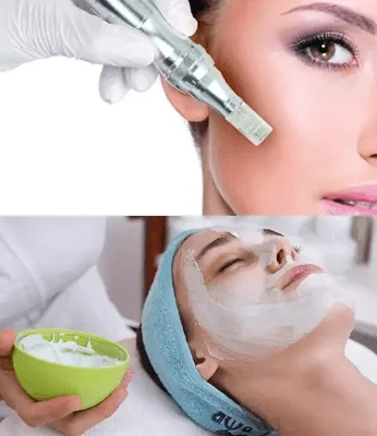 Microneedling vs Chemical Peel: Tackle Acne And Oily Skin