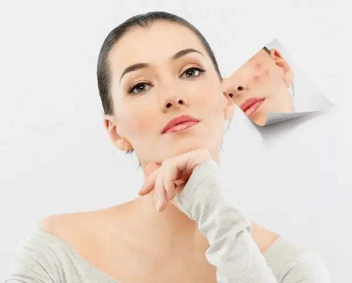Dermaroller For Acne Scars: A Non-Invasive Alternative To Surgery