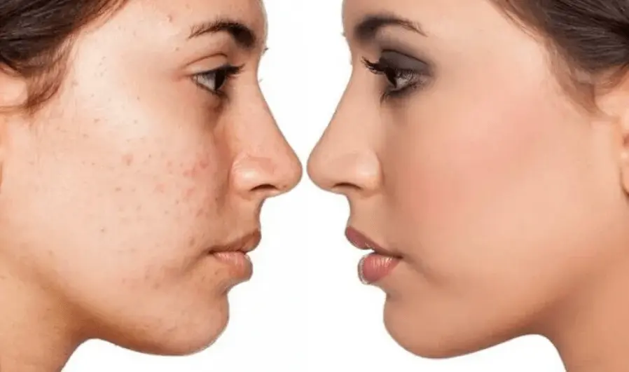 Microdermabrasion vs Chemical Peel: The Battle For Brighter Skin