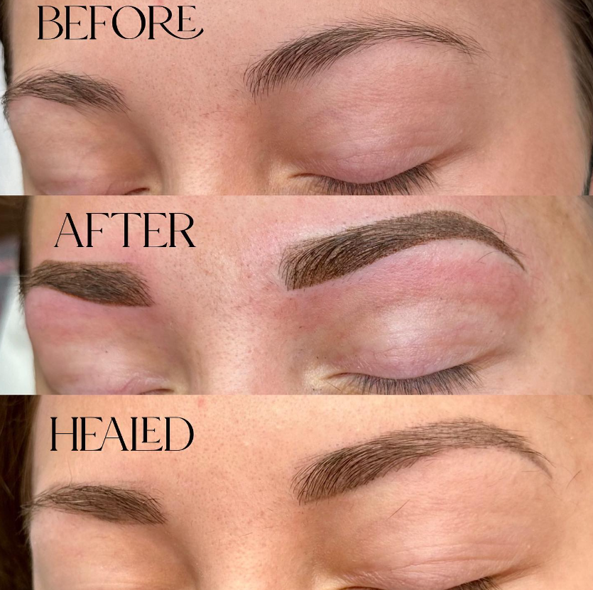 Saline Eyebrow Tattoo Removal Step By Step Guide