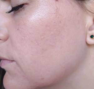 MICRODERMABRASION VS CHEMICAL PEEL: QUEST FOR GLOW