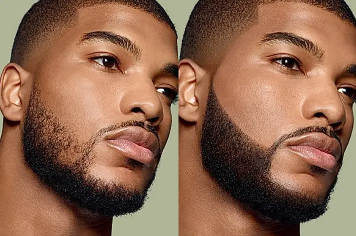 Beard Micropigmentation | How Does It Work And What To Expect