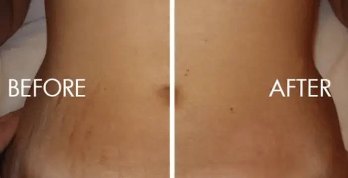 Micro Needling Stretch Marks | Process, Aftercare and More