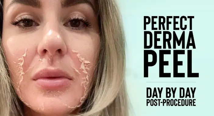 Derma Peel | Types, Aftercare and Benefits